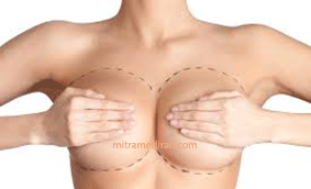 breast plastic surgery