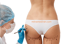 buttock plastic surgery