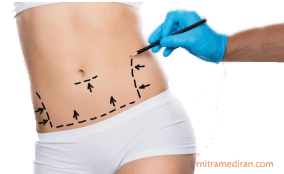 abdomen plastic surgery
