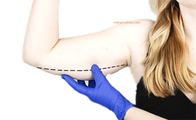 arm plastic surgery