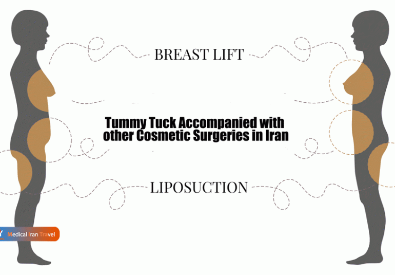Tummy-Tuck-Accompanied-with-other-Cosmetic-Surgeries-in-Iran