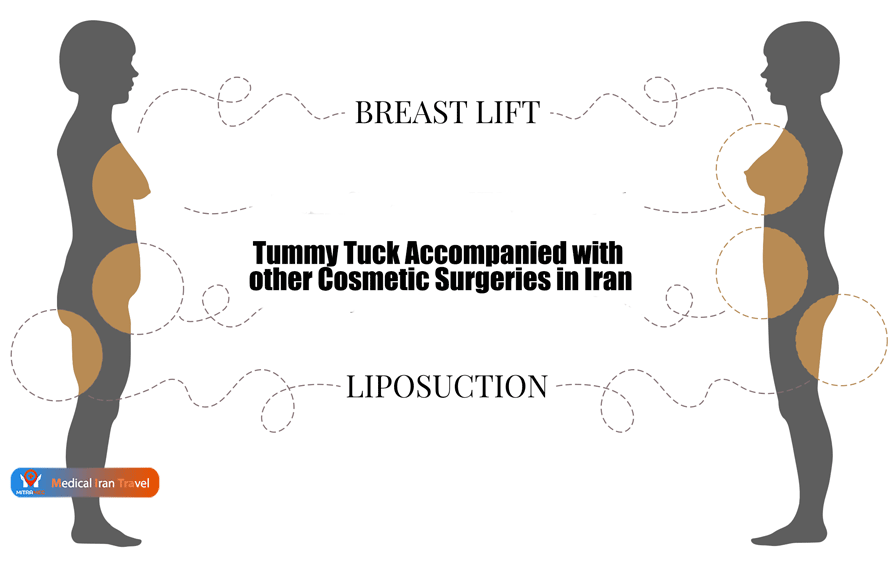 Tummy-Tuck-Accompanied-with-other-Cosmetic-Surgeries-in-Iran