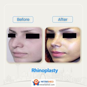 rhinoplasty before after 31 (1)