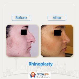 rhinoplasty before after 32
