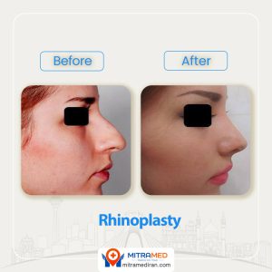 rhinoplasty before after 33
