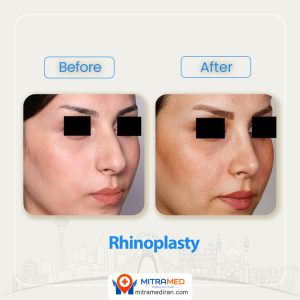 rhinoplasty before after 34