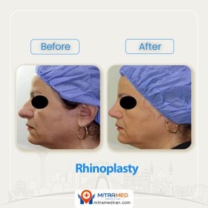 rhinoplasty before after 35