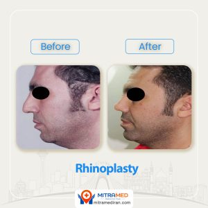 rhinoplasty before after 36