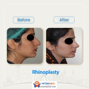 rhinoplasty before after 37