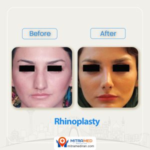 rhinoplasty before after 39