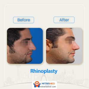 rhinoplasty before after41