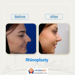 rhinoplasty before after42