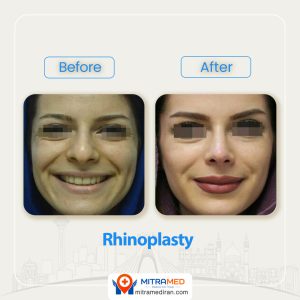 rhinoplasty before after43