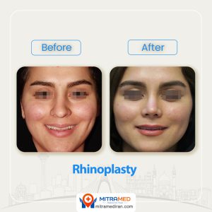 rhinoplasty before after44