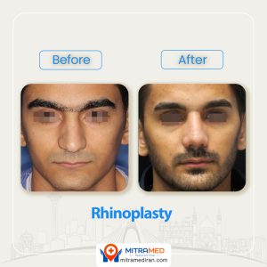 rhinoplasty before after45