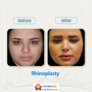 rhinoplasty before after46