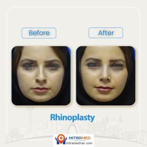 rhinoplasty before after47