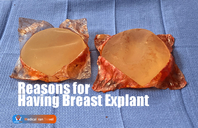 Reasons for Having Breast Implants Removed