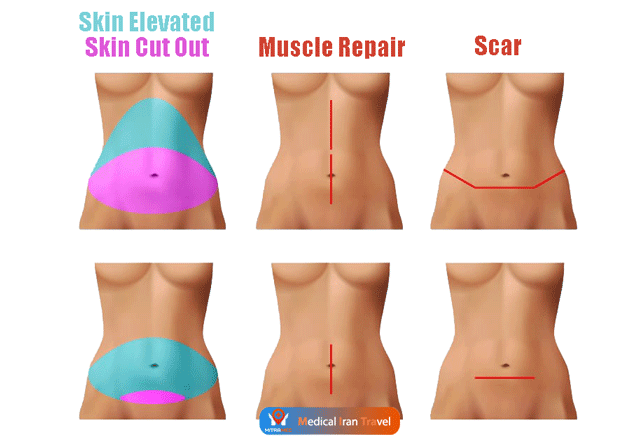 The-Difference-Between-a-Mini-and-a-Full-Tummy-Tuck