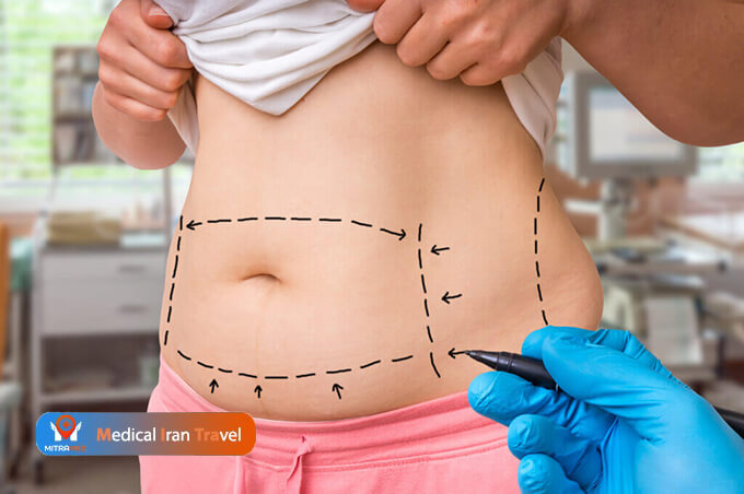 The Difference Between an Abdominal Liposuction and a Tummy Tuck Surgery