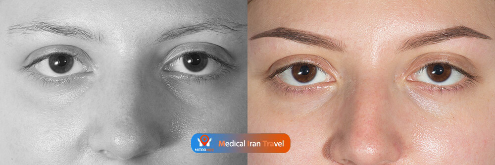 eyebrow transplant photo results