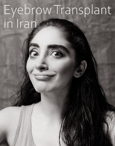 eyebrow transplant in Iran