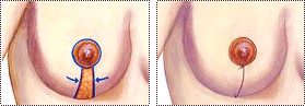A circle around the nipple, and an extended incision going downward from the Areola to the crease below the breast: