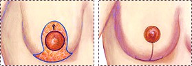 A circular incision around the nipple, extending vertically downward, and horizontally along the crease under the breast (like an inverted T-shape
