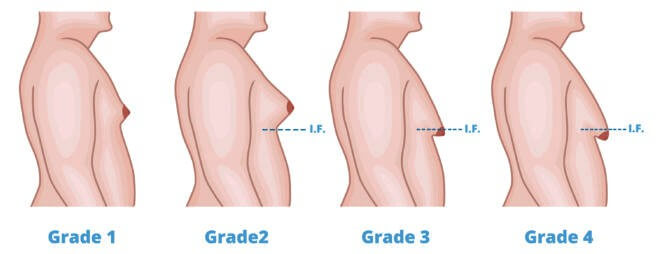 Different Grades of Gynecomastia