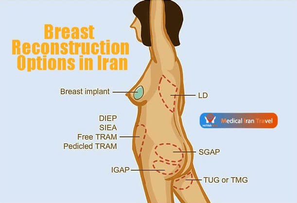 Breast Reconstruction Options in Iran