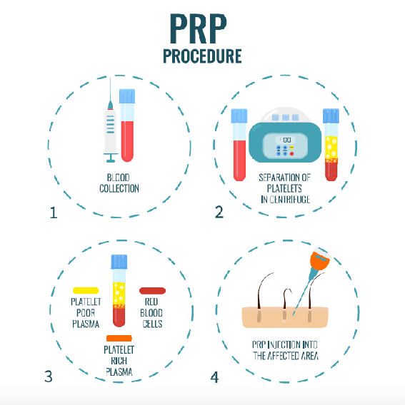 How does PRP Injection procedure Take Place