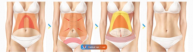 How is the Tummy Tuck Surgery Performed in Iran ?