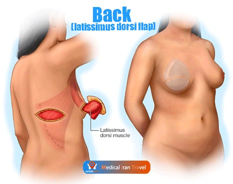 Latissimus Dorsi (LD) Flap Breast Reconstruction