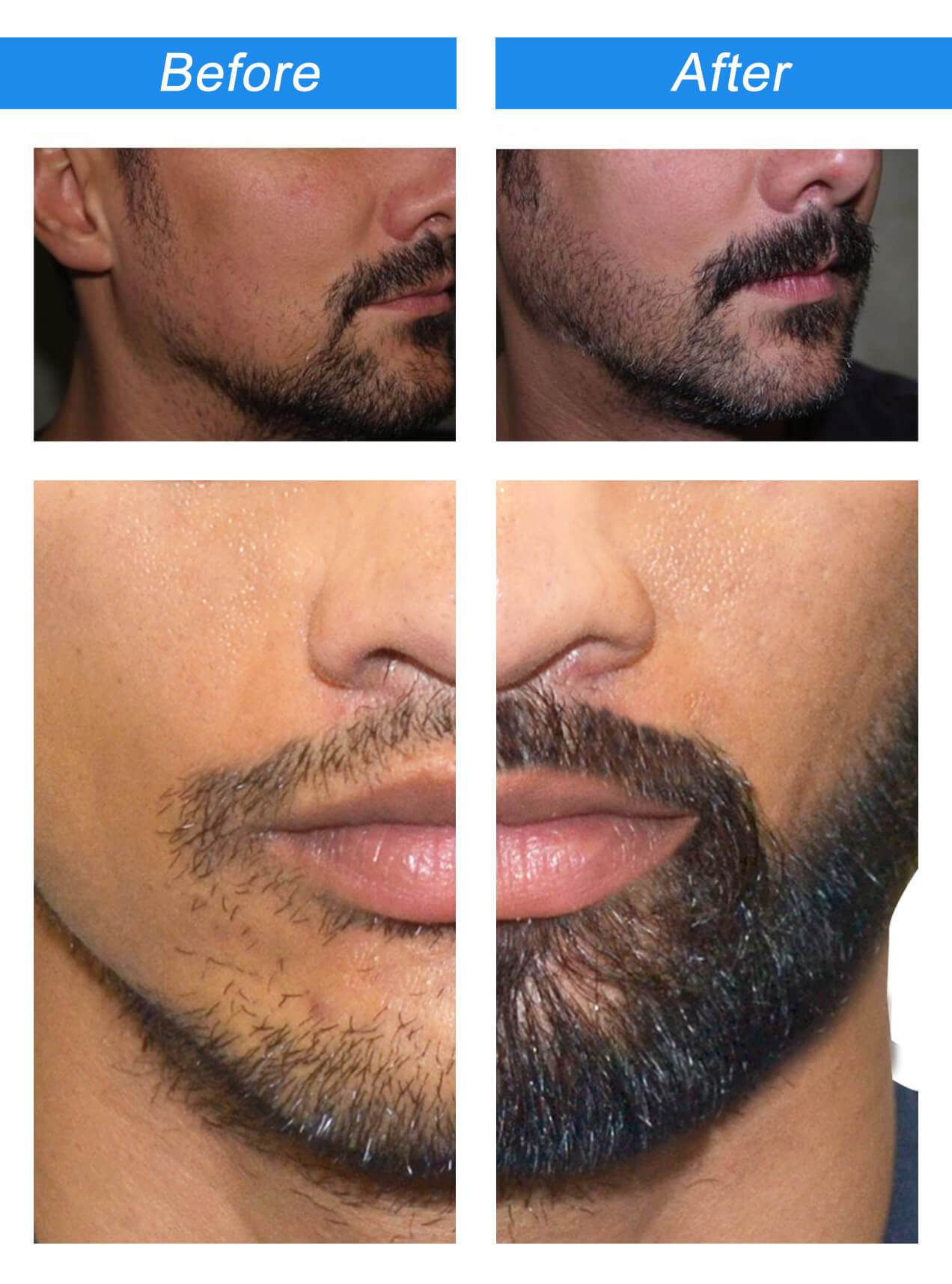 Mustache Transplant before and after