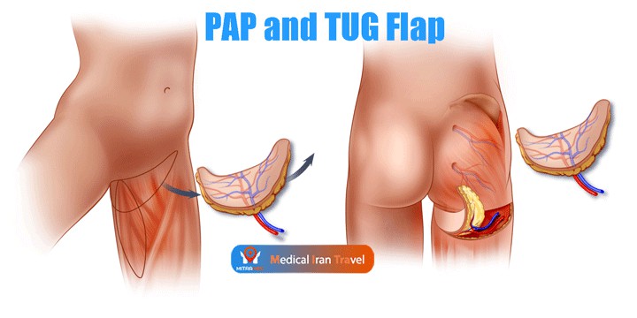 PAP and TUG Flap Breast Reconstruction