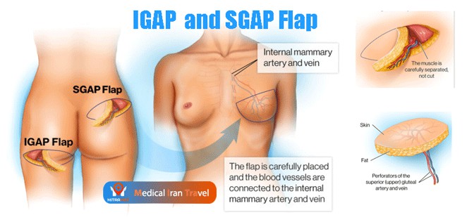 IGAP and SGAP Flap Breast Reconstruction