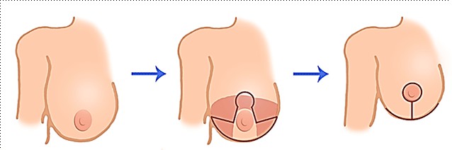The Classic Technique of Breast Reduction (Anchor Technique)