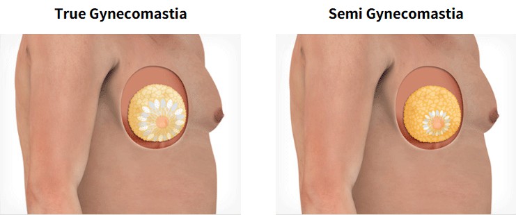 The Various Types of Gynecomastia