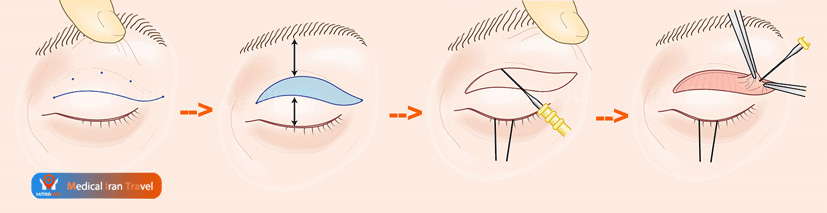 During the Upper Eyelid Surgery in Iran