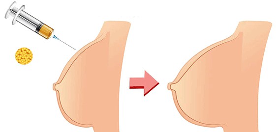Breast Augmentation Using Fat Injection or Implants?