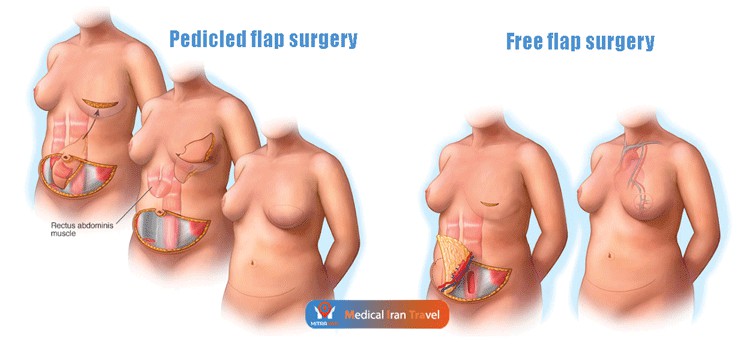 Various Types of Flaps Used in Breast Reconstruction