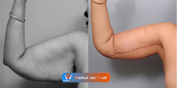 arm lift before and after photo result