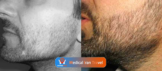 beard transplant before after results
