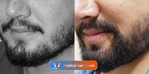 beard transplant before and after photo results