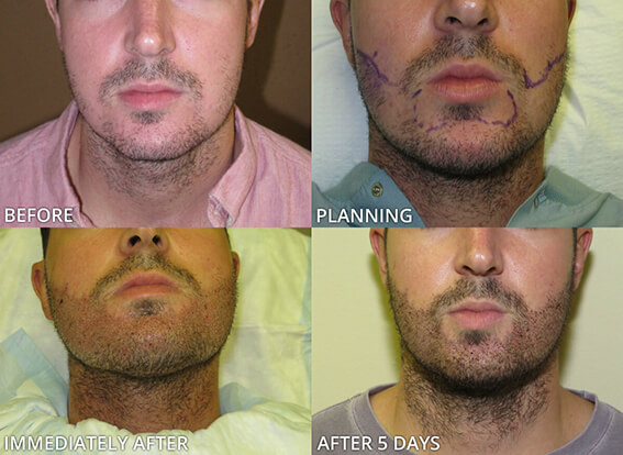 beard transplant result timeline