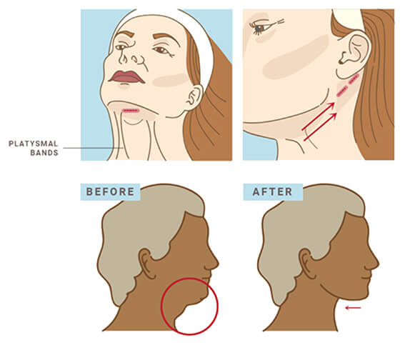 neck lift surgery procedure