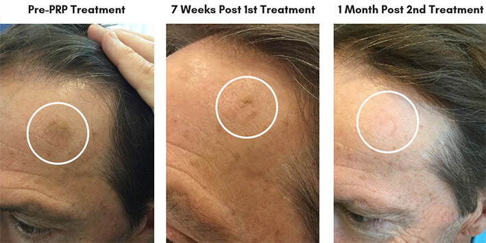prp injection before after photo results
