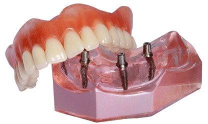 Fragmented Dentures (Removable Partial Denture)