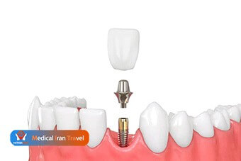 Dental Implants Options in Iran