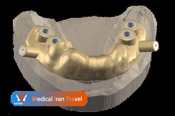 3D Design of Dental Implants in Iran
